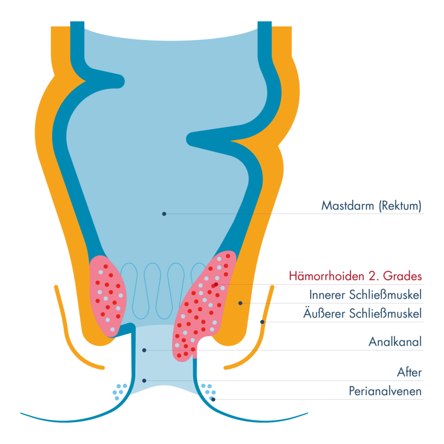 Schematische Darstellung von Mastdarm (Rektum) und Analkanal mit innerem und äußerem Schließmuskel. Gezeigt sind Hämorrhoiden 2. Grades als vergrößerte Gefäßpolster oberhalb des äußeren Schließmuskels, die vorübergehend nach außen treten, sich jedoch von selbst zurückbilden.