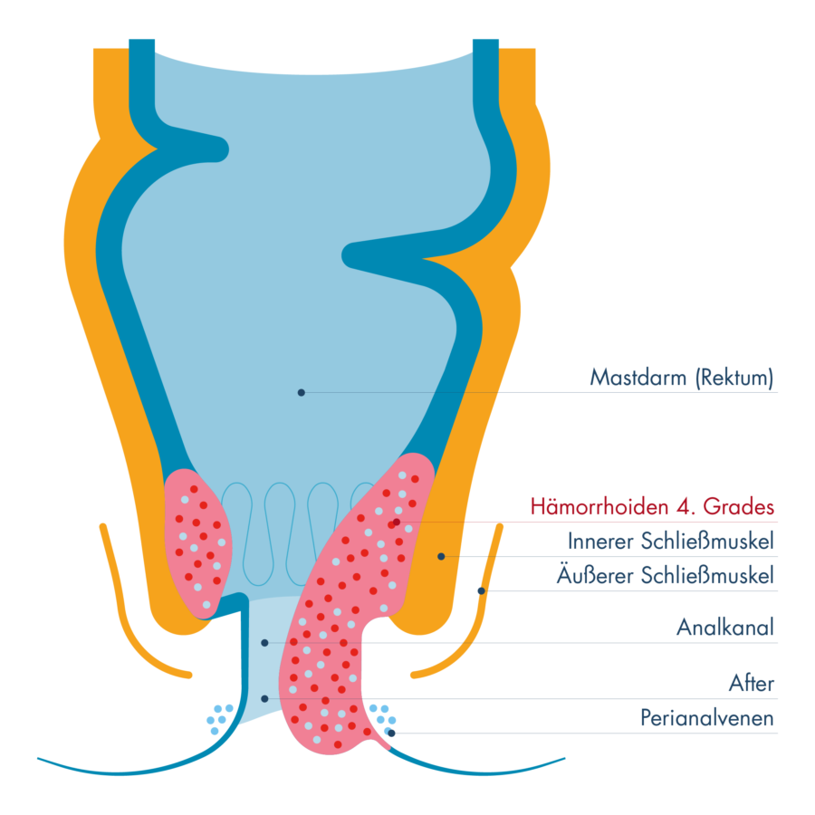 Schematische Darstellung von Mastdarm (Rektum) und Analkanal mit innerem und äußerem Schließmuskel. Hervorgehoben sind Hämorrhoiden 4. Grades als stark vergrößerte Gefäßpolster, die dauerhaft aus dem Analkanal nach außen vorgefallen sind und sich nicht mehr zurückschieben lassen.